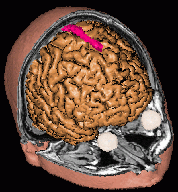 Rendering of a human head with brain surface revealed