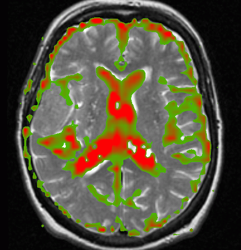 Diffusion map overlayed on an anatomical image
