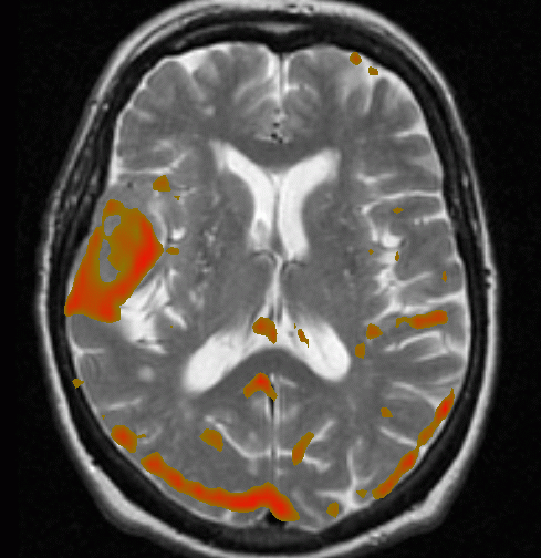 Perfusion map overlayed on an anatomical image